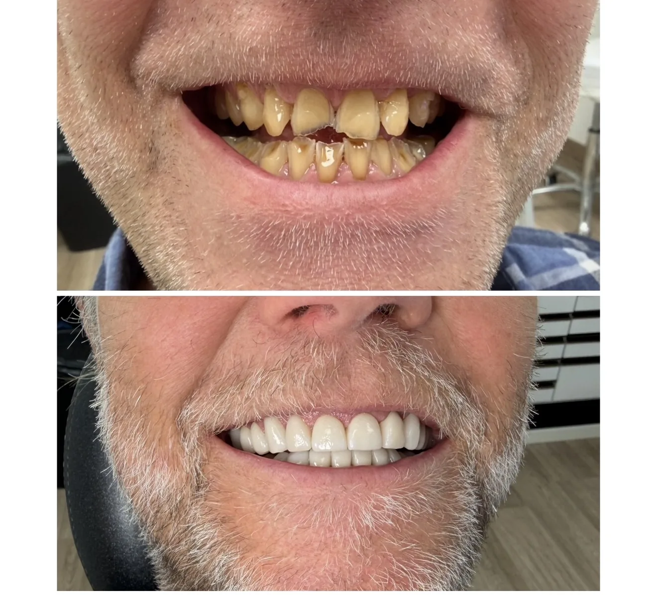 Före- och efterbild av en patient som sökte hjälp för kraftigt slitna tänder
